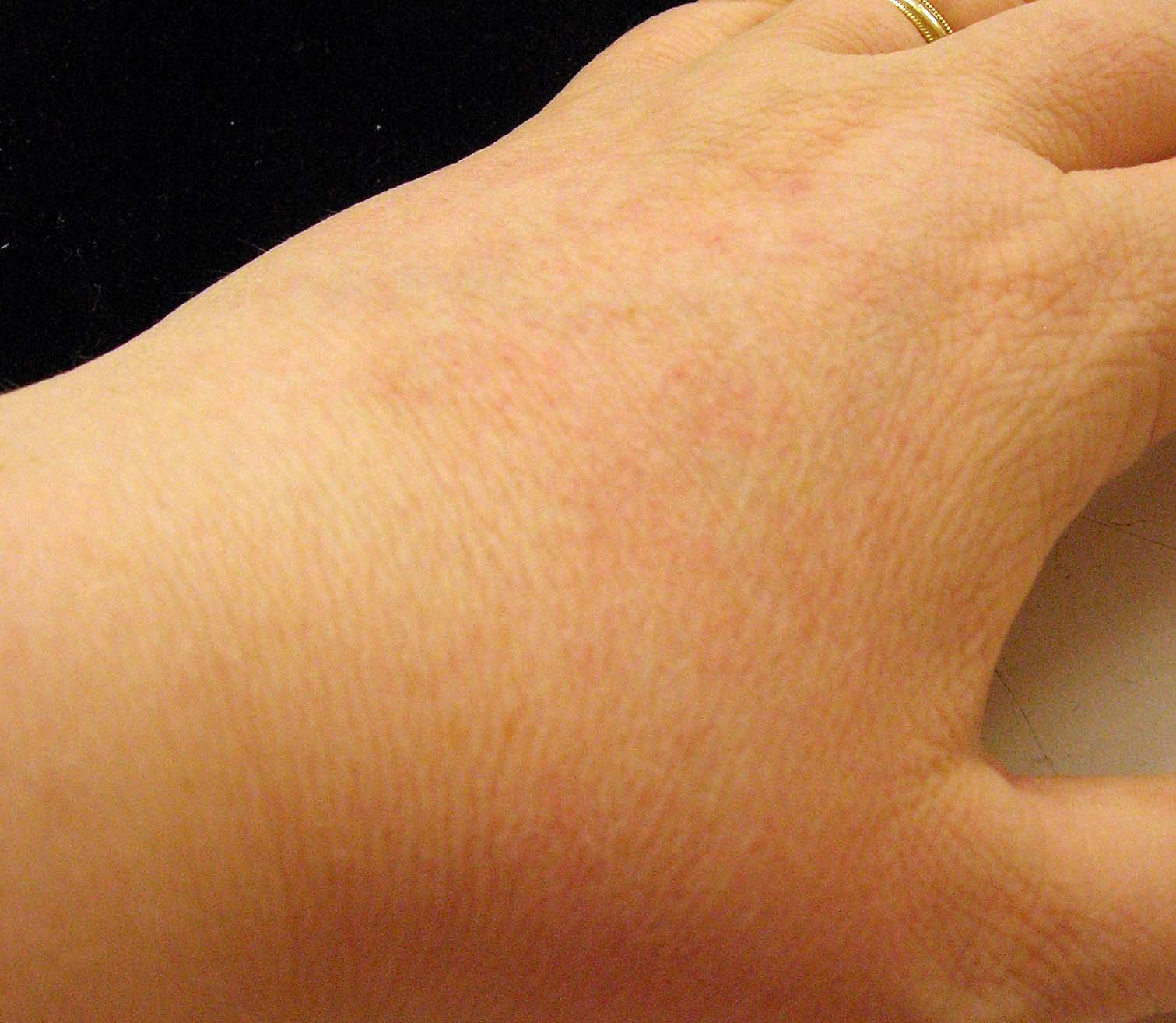 Hand rash - 1