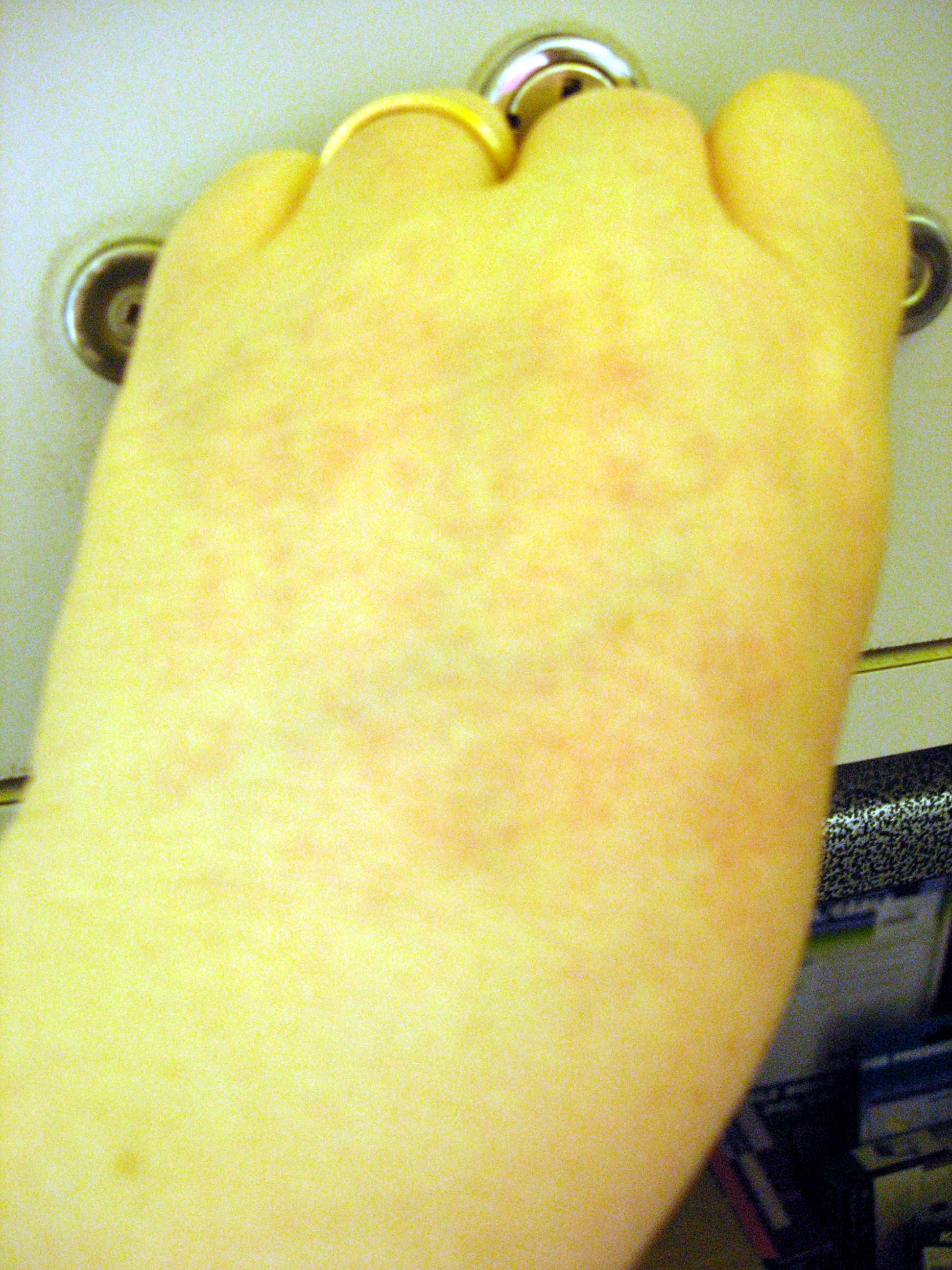 Hand rash - 2
